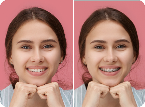 AI Braces Filter tool preview