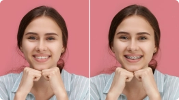 AI Braces filter