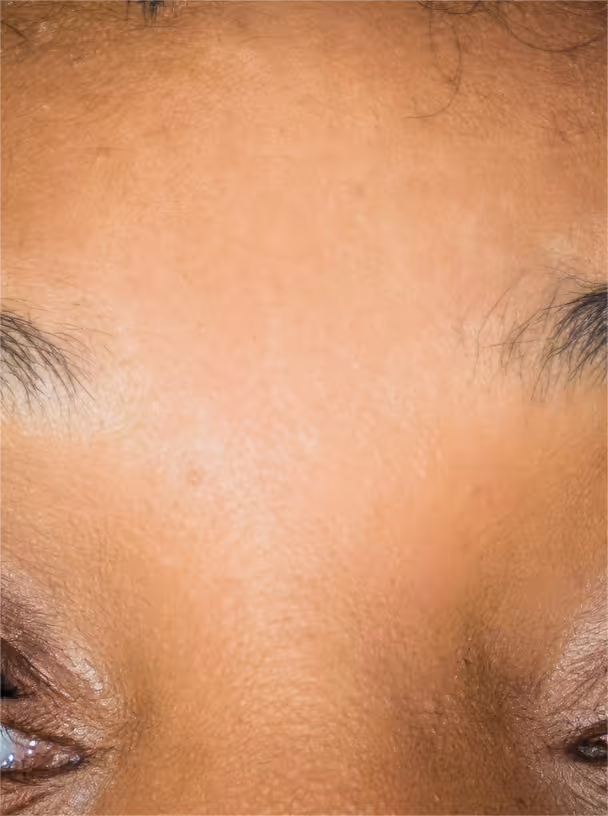 Skin close-up grade 1