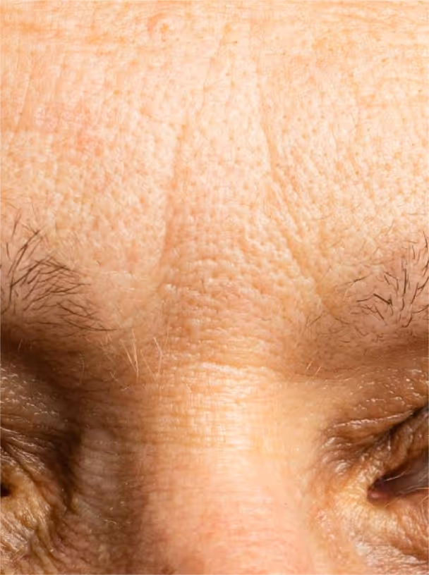 Skin close-up grade 2