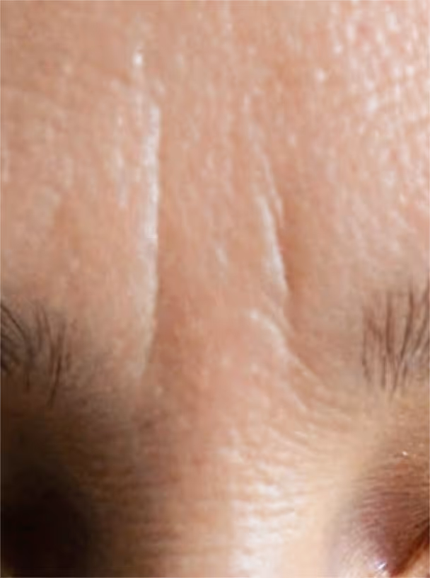 Skin close-up grade 3