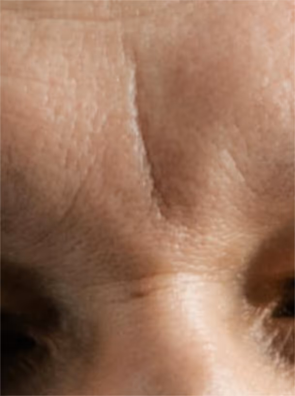 Skin close-up grade 4