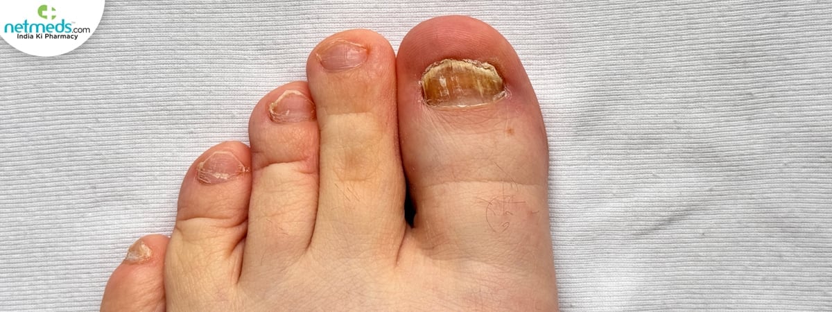 fungal infection remedies
