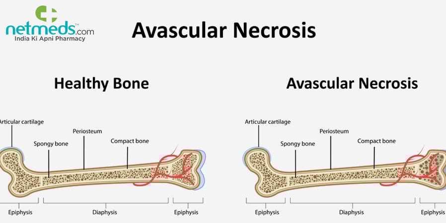 Avascular Necrosis