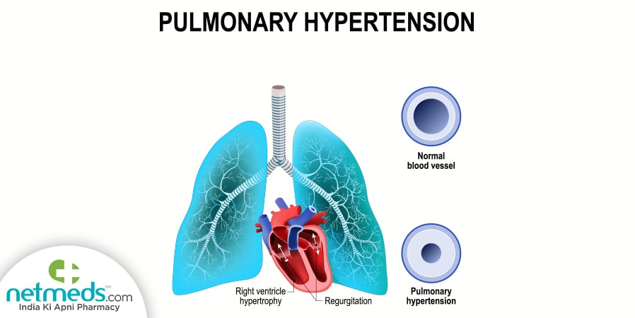 Pulmonary Hypertension