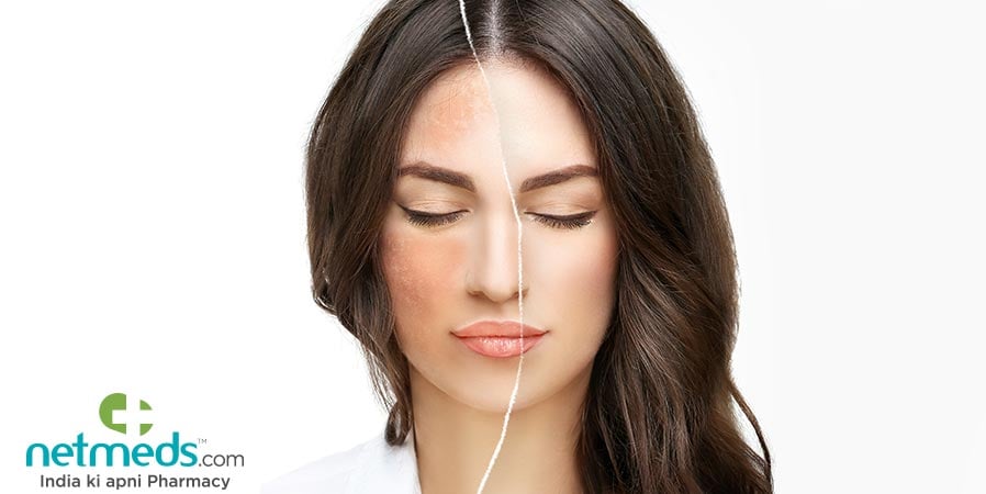 Woman with melasma