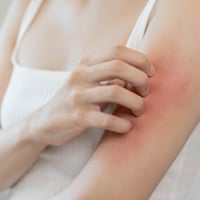 5 Ways To Treat Your Skin Allergy Naturally