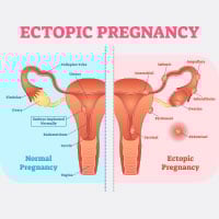 Ectopic Pregnancy: Causes, Symptoms And Treatment