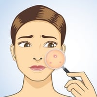 Acne: What It Is, Causes & Treatment