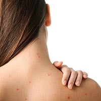 Bacne: 5 Simple Ways To Get Rid Of Acne On Your Back