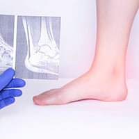 Reactive Arthritis: Causes, Symptoms and Treatment