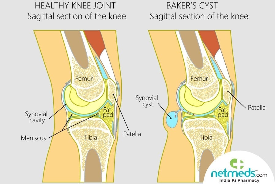 baker's cyst
