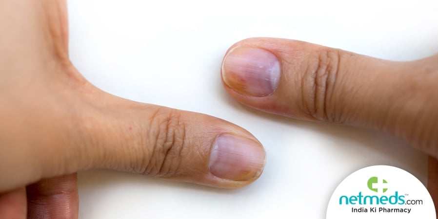 Subungul Melanoma Thumbs