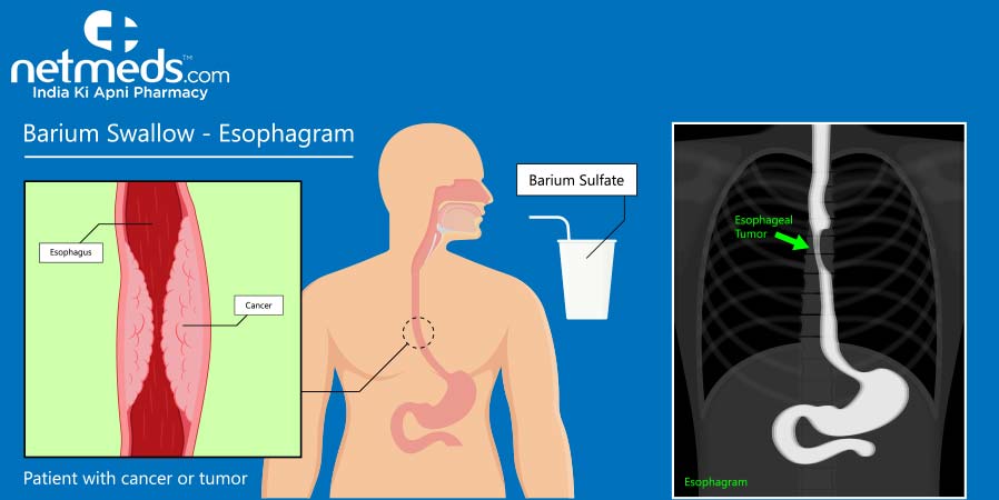 Barium swallow - Esophagram