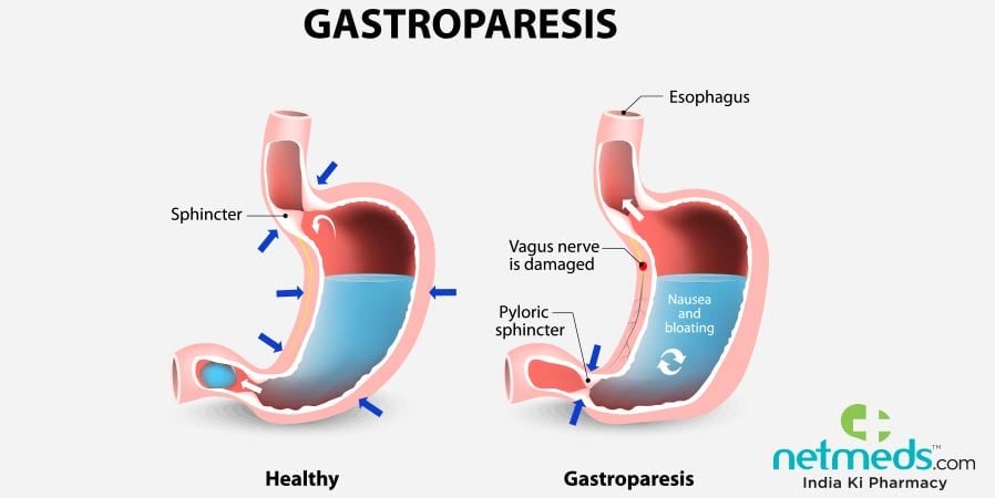 Gastroparesis