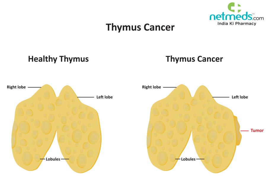 thymus cancer