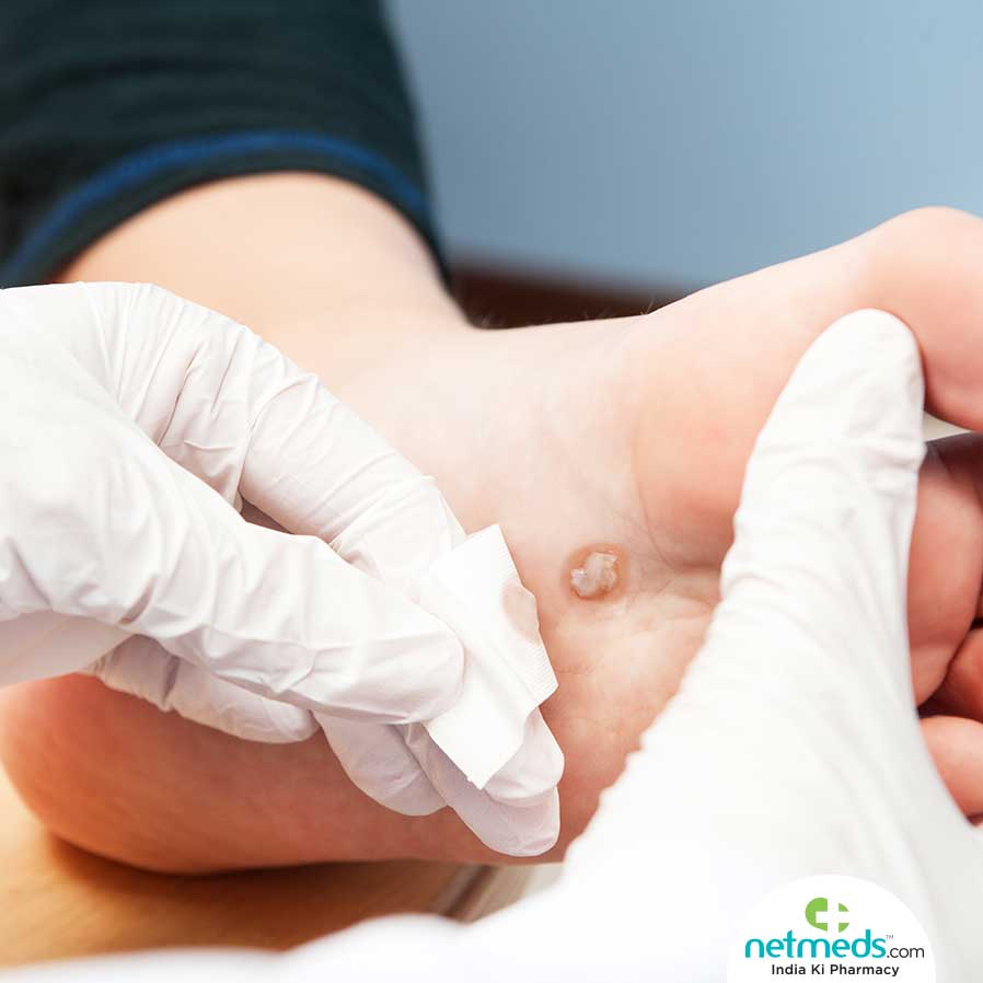 Treating Warts
