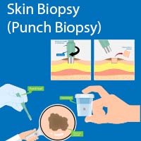 Skin Biopsy: Procedure, Risks And Results