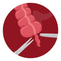 Appendectomy: Purpose, Procedure And Risks