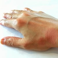 Cutaneous Lupus Erythematosus: Causes, Symptoms, Diagnosis And Treatment 