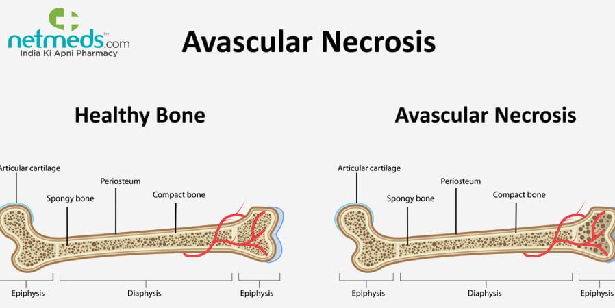 Avascular Necrosis