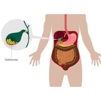 Ayurveda For Gallstones: Natural Remedies To Treat Cholelithiasis And Uplift Liver Health