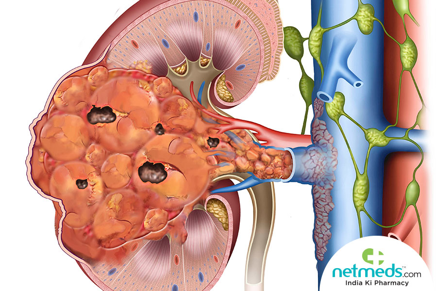 wilm's tumour
