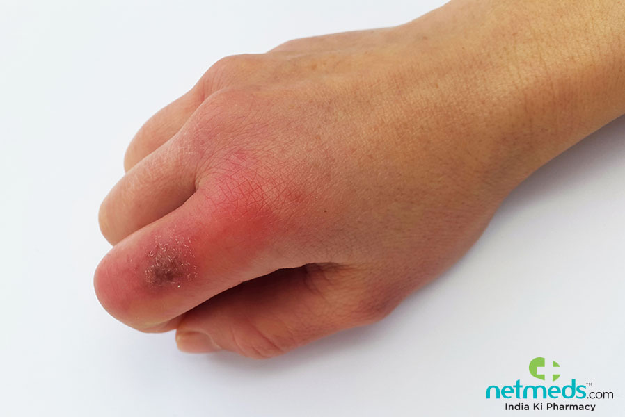chilblains