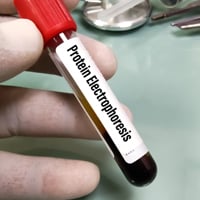 Serum Protein Electrophoresis (SPEP): Purpose, Procedure And Results