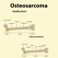 Osteosarcoma: Causes, Symptoms And Treatment