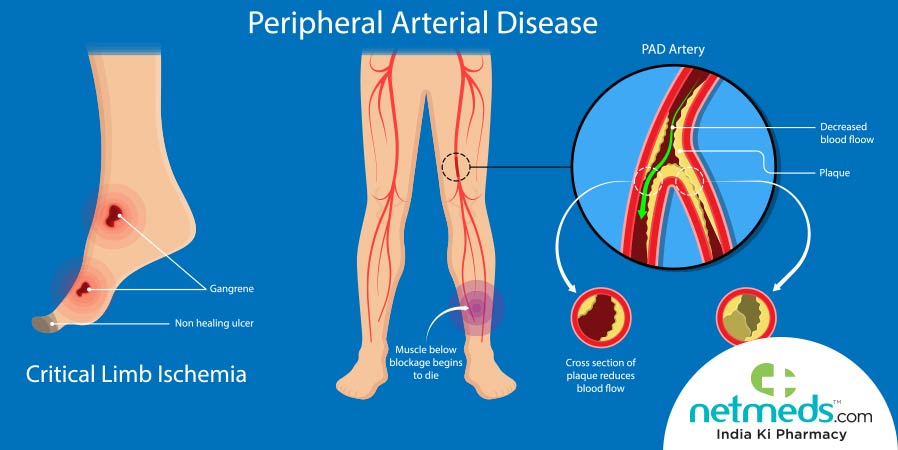 Peripheral artery disease
