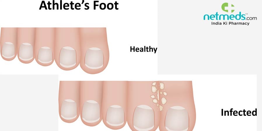 Athlete's foot