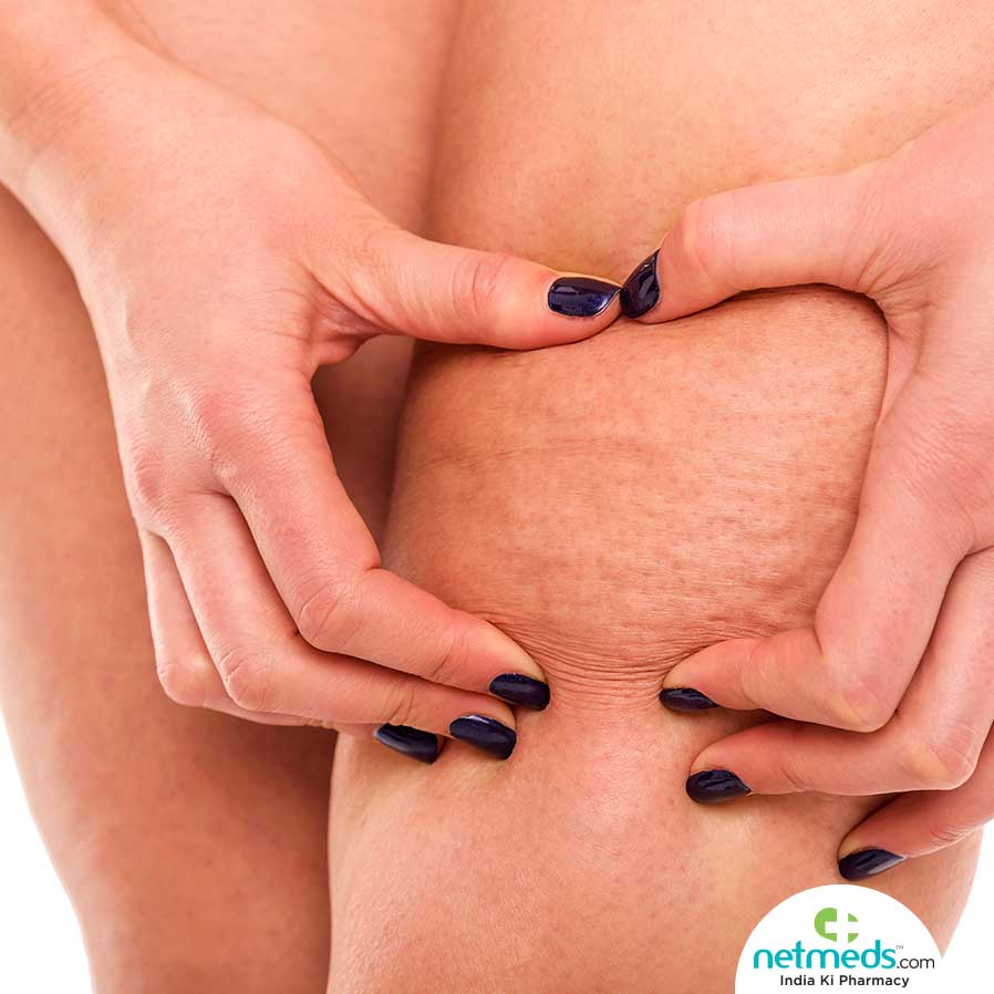 Cellulitis in skin