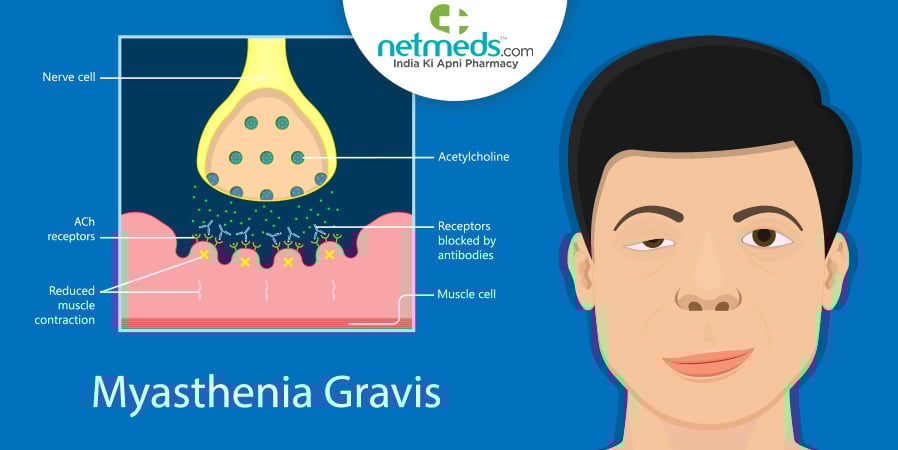 Myasthenia