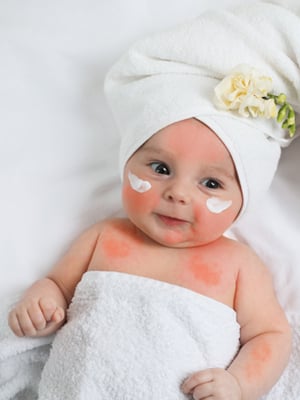 Baby Monsoon Rash Remedies: 5 Safe And Natural Ways To Treat Skin Irritation In Humid Weather