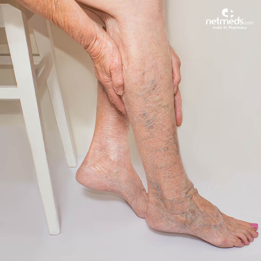 varicose veins