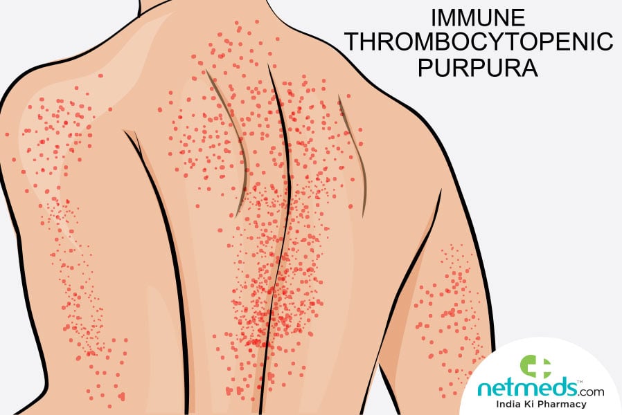 immune thrombocytopenia