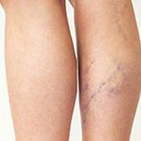 Varicose Veins: Tall People Are More At Risk, Says Study