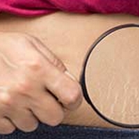Healthy Diet, Exercise Can Prevent Stretch Marks
