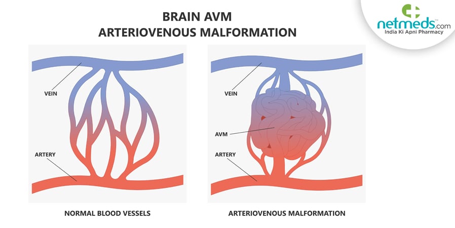 Arteriovenous Malformation