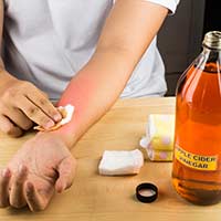 Warts: 3 DIY Home Remedies To Ward Off Those Ugly Bumps
