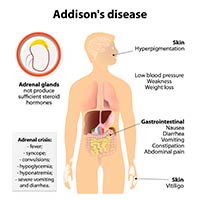 Addison’s Disease: Symptoms, Causes And Treatment