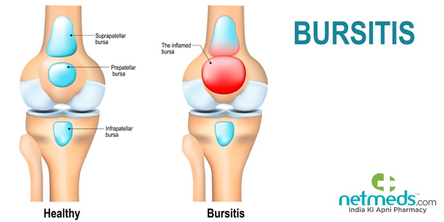 Knee Bursitis