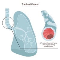 Tracheal Cancer: Causes, Symptoms And Treatment
