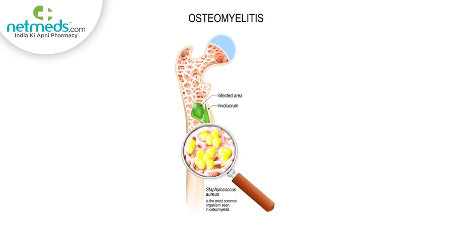 Osteomyelitis