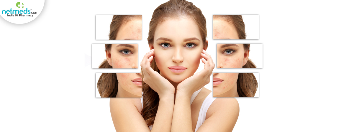acne scars