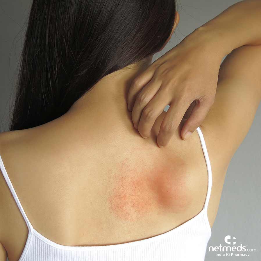 Get Relief From Prickly Heat 
