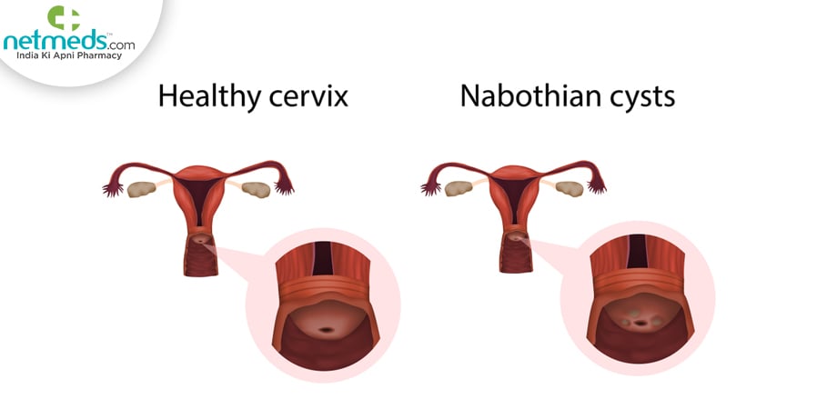 nabothian cyst