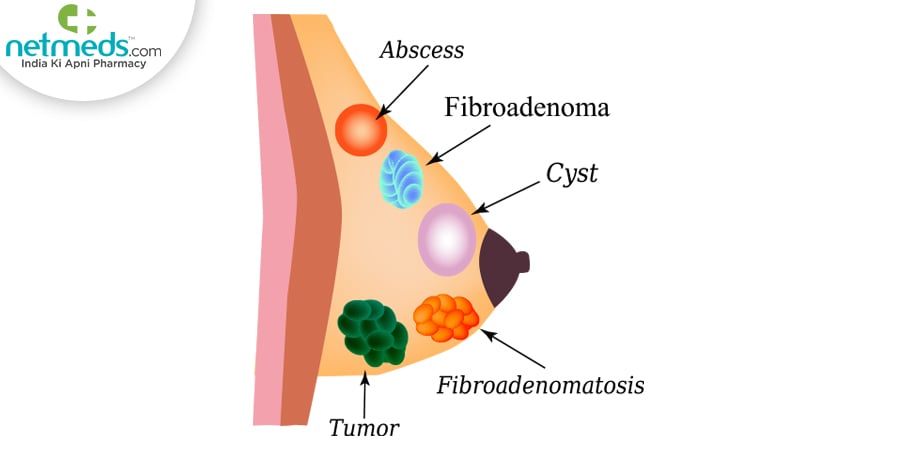 Fibroadenoma