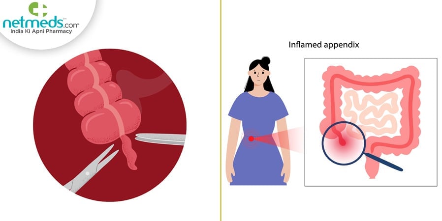 Appendectomy and inflamed appendix